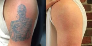 What I have learned after more than 8500 Tattoo Removal Treatments Mike  Anderson 