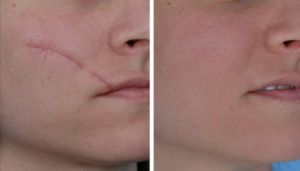 scar reduction therapy in delhi