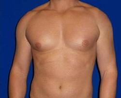 Breast Enhancement Treatment