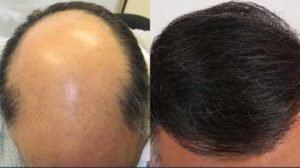 Looking for Hair Transplant Surgery In Delhi  India  Cost  Procedure