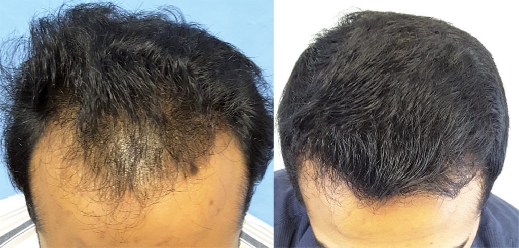 Hair Transplant Effective For Hair Loss | Cosmotree Clinic