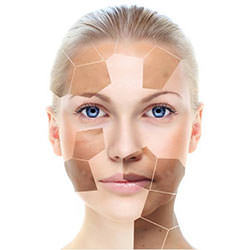 Acne Removal Treatment in Delhi