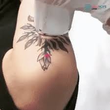 laser tattoo remove