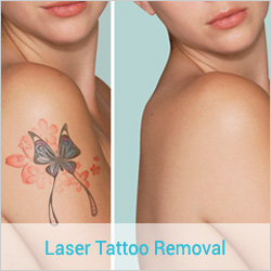 Best Tattoo removal