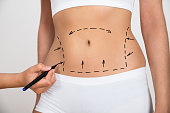 Liposuction Treatment in Delhi