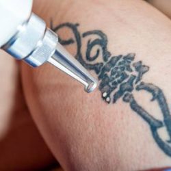 Best Tattoo Removal Archives - Cosmotree Clinic