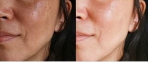 Skin Lightening Treatment in Delhi